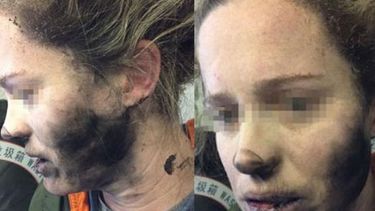Las imágenes muestran que la víctima quedó con la cara y con el cuello ennegrecidos.