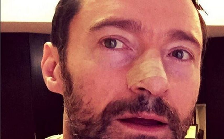 Es la quinta vez que el actor australiano es operado de un carcinoma de células basales en la nariz (@thehughjackman)