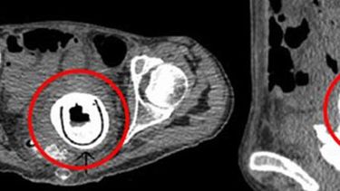 Al revisarla se dieron cuenta que en su vagina se encontraba un juguete sexual de 12 centímetros de longitud. (Facebook)