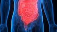 Cáncer de colon, la prevención es indispensable&nbsp;