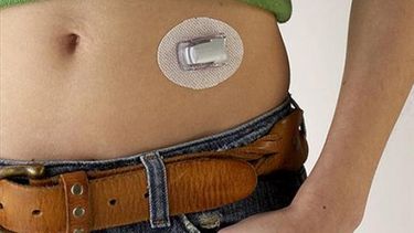 A diferencia de otros páncreas artificiales que sólo corrigen el exceso de azúcar en la sangre, éste también puede controlar casos de hipoglicemia —en los que el azúcar es demasiado baja_, lo que imita la función de un páncreas natural (Foto AP)