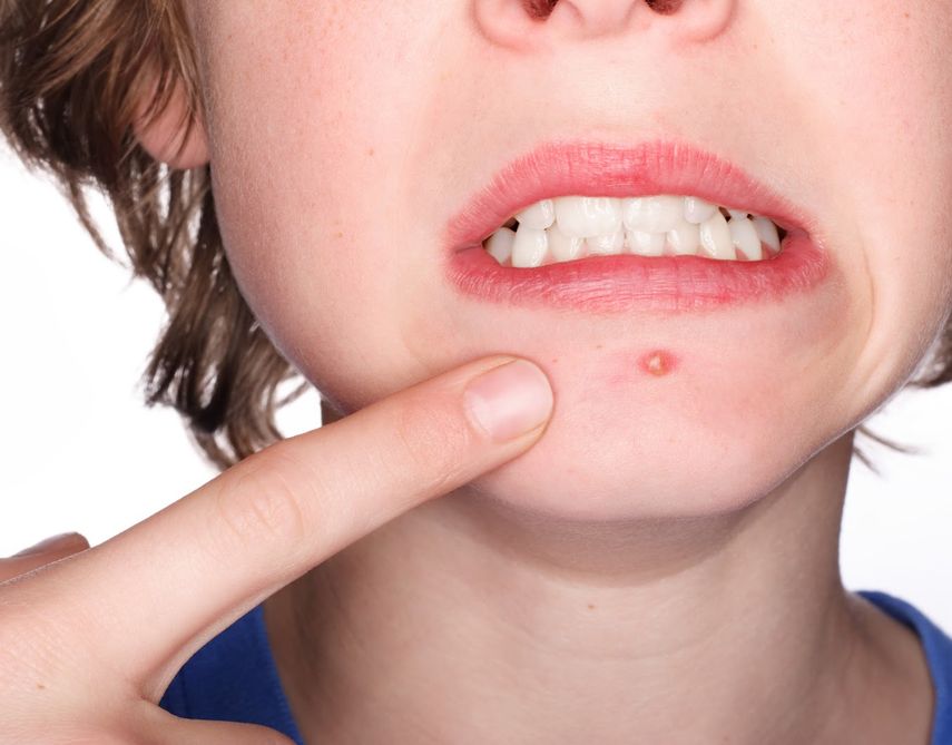 Las lesiones del acné son siempre inoportunas.(Archivo)