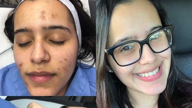 Las manchas en la piel son conocidas como melasma y afectan mayoritariamente a las mujeres. Según el laboratorio Zviak Research Centre, de París, solo el 10% aparece en hombres.