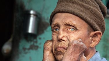 En los Estados Unidos, se diagnostican aproximadamente 100 casos cada año, la mayoría de ellos en el sur, California y Hawaii. (Archivo)