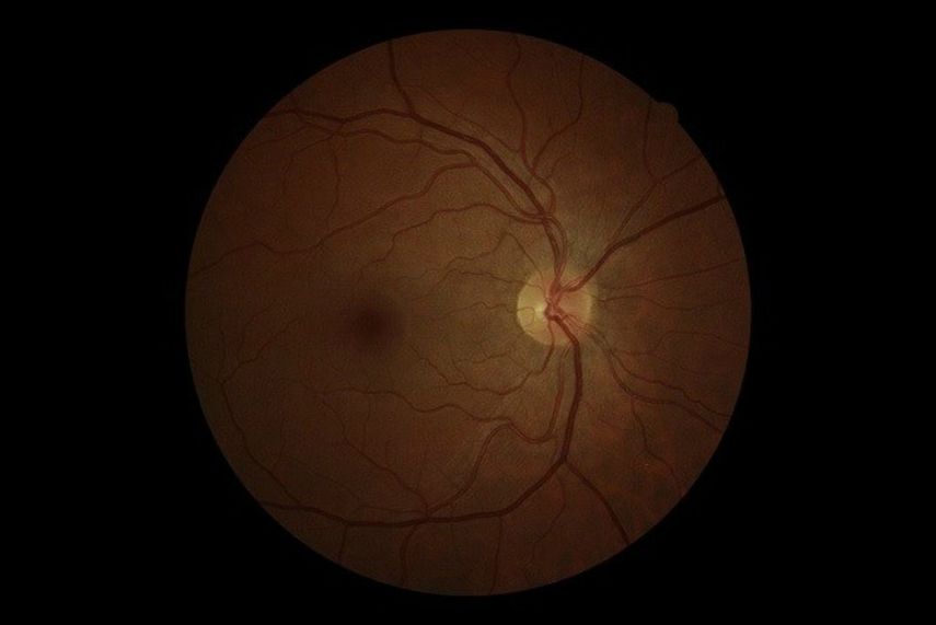 Esta enfermedad  afecta a más de 60 millones de personas entre 40 y 80 años en todo el mundo. 