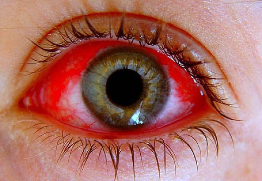 Cuando nos contagiamos de conjuntivitis, los ojos se enrojecen como consecuencia de la dilatación de los capilares que componen la conjuntiva. (Archivo)