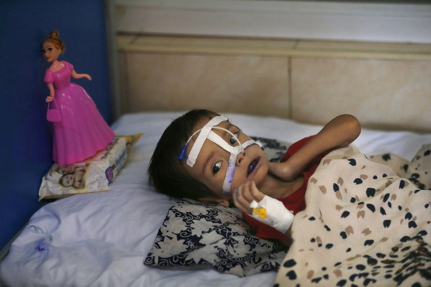 Una ni&ntilde;a desnutrida permanece en una cama en una unidad del hospital Indira Gandhi en Kabul, Afganist&aacute;n