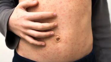 Persona infectada por el virus de sarampión 