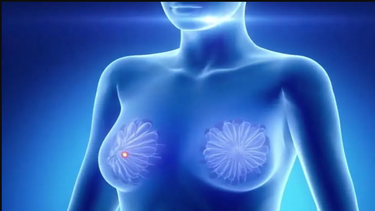 Cada año se registran 1,38 millones de nuevos casos de cáncer de mama, &nbsp;de los cuales 458.000 mueren, según la OMS.