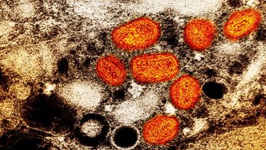 Esta imagen difundida por el Instituto Nacional de Alergias y Enfermedades Infecciosas de EEUU muestra una imagen a color captada con un microscopio electrónico de barrido en el que se ven partículas de viruela símica, en anaranjado, encontradas dentro de una célula infectada