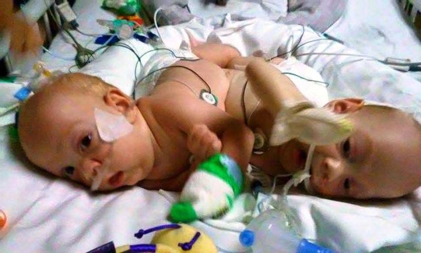 Carter y Conner Mirabal antes de su cirugía. Foto Facebook vía  Prayers for Carter & Conner.