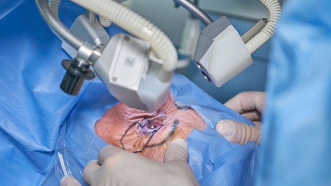 La degeneración macular húmeda puede ser tratada con inyecciones de fármacos y cirugía láser&nbsp;