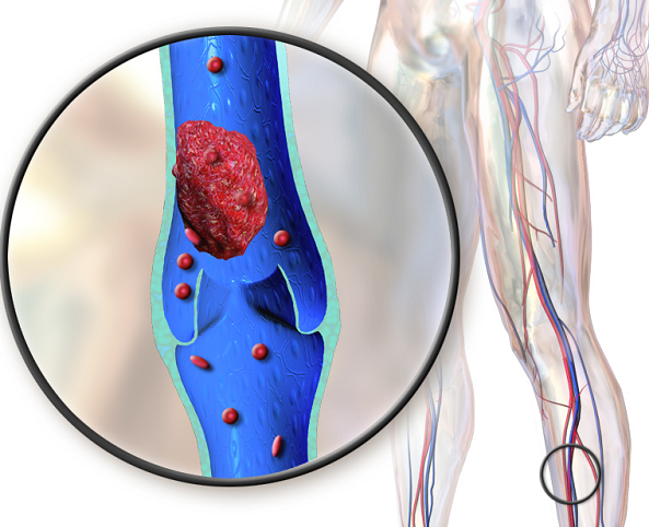 Trombosis Vivir Con Las Arterias Tapadas