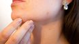 Hay casos en los que el folículo se abre y libera bacterias dentro de la piel, que se infecta creando pápulas, pústulas o, en situaciones extremas, nódulos.