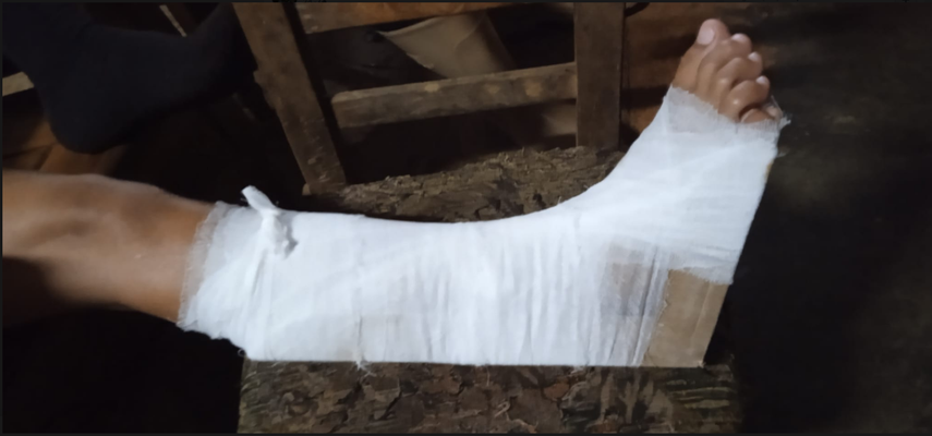 Elizabeth Pérez publicó en las redes sociales la foto del pie de su hijo que fue inmovilizado con cartón y vendas en sustitución del yeso.&nbsp;