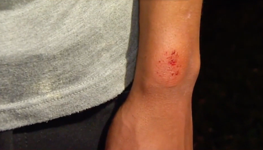 Una de las víctimas muestra las heridas causadas por los impactos de las bolas de pintura.&nbsp;