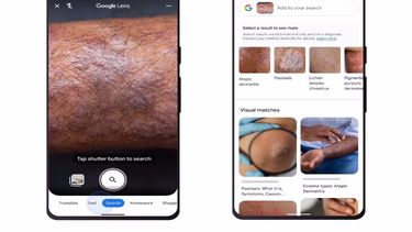Interfaz de Google Lens para el reconocimiento de reacciones en la piel.