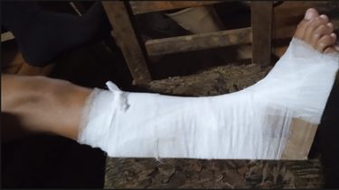 Elizabeth Pérez publicó en las redes sociales la foto del pie de su hijo que fue inmovilizado con cartón y vendas en sustitución del yeso. 