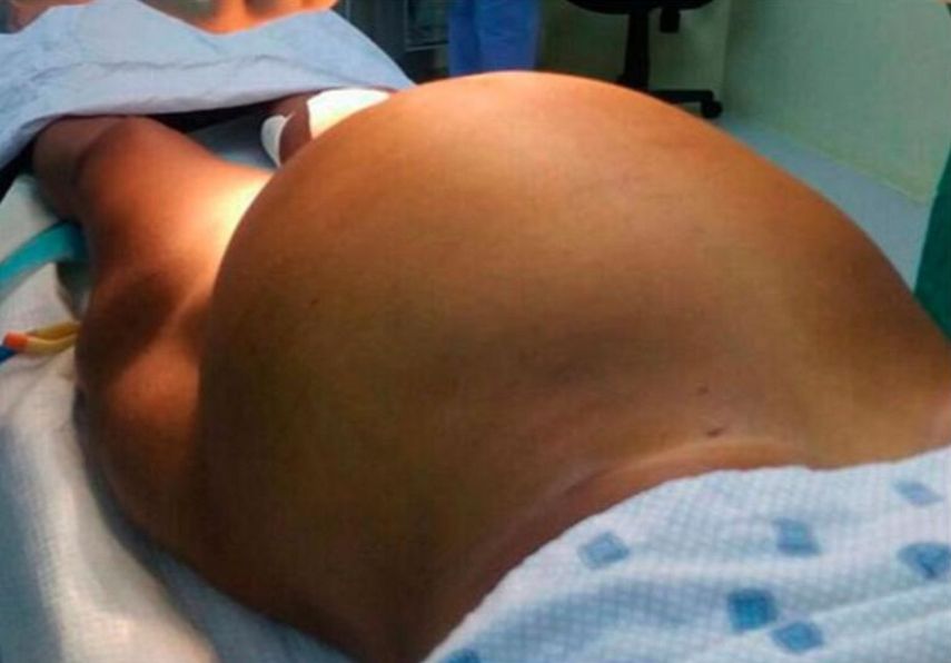 Así lucía el abdomen de una cubana embarazada antes de que le extrajeran un fibroma de 10 kilos de peso en la oriental provincia de Guantánamo.