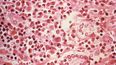Fotografía tomada a través de un microscopio de una muestra de tejido hepático que fue extraída de un paciente con síndrome pulmonar por hantavirus (HPS).