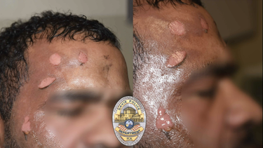 Claudio Salcedo sufrió quemaduras de segundo grado en su rostro.&nbsp;