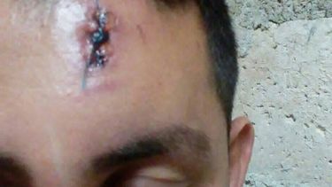 Balsero con balazo de goma en la frente: pudo ser peor