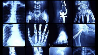 Se estima que una de cada tres mujeres y uno de cada 12 hombres, de más de 50 años, sufren de osteoporosis. (Archivo)