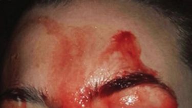 La joven está siendo tratada con propanolol, un fármaco que es utilizado para el tratamiento de la hipertensión, lo que ha permitido reducir, pero no eliminar, las hemorragias a través de la piel.