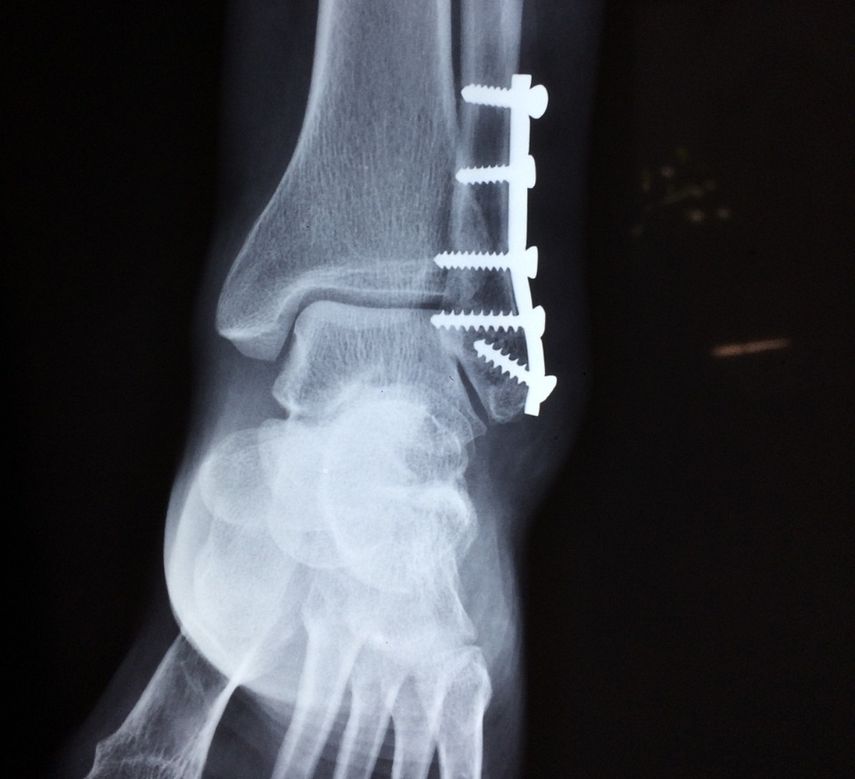 Fracturas de huesos