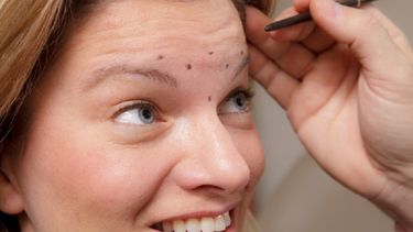 Las inyecciones de botox actúan como minúsculos dardos envenenados que bloquean temporalmente las señales nerviosas que el cerebro envía a músculos y glándulas. (Archivo)