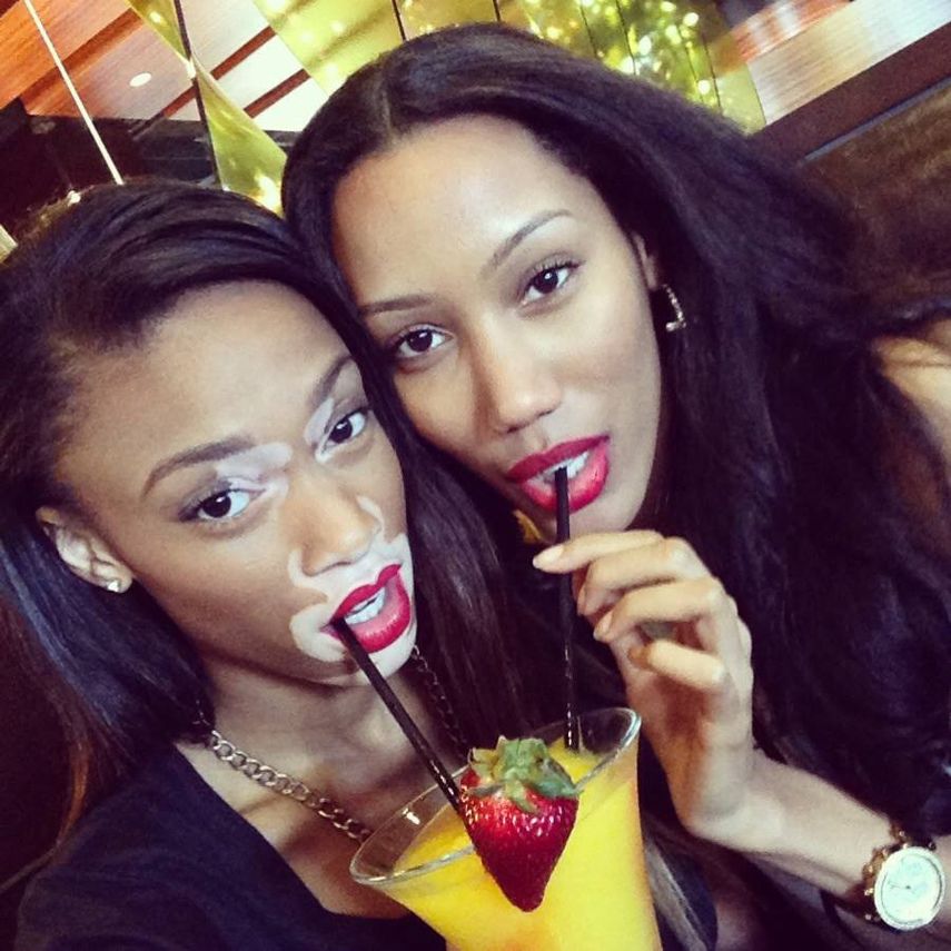 Ha sufrido de burlas y muchos la han apodado como vaca o cebra (Foto: Facebook ChantelleWinnie)