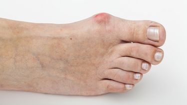 El hallux valgus, es una enfermedad que produce dolor e inflamación, dificultades para calzarse, y por supuesto, problemas estéticos. (Archivo)