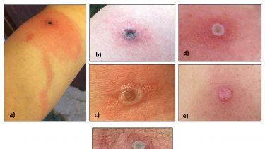 La foto muestra lesiones provocadas en la piel por la viruela de Alaska.