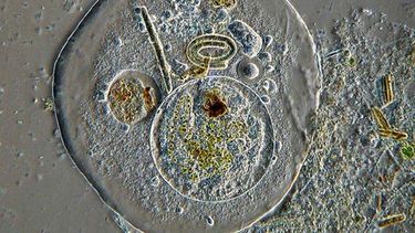 residente de broward se enferma con ameba come-cerebro