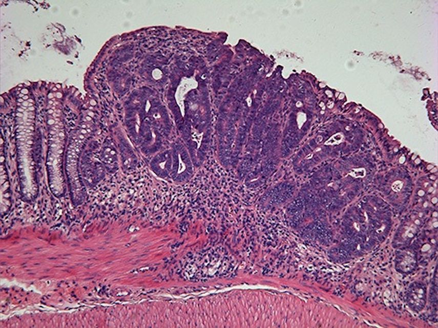 Tumor de colon.&nbsp;