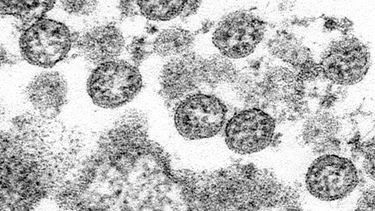 &nbsp; Esta imagen captada con un microscopio electr&oacute;nico en 2020, publicada por los Centros para el Control y la Prevenci&oacute;n de Enfermedades (CDC, por sus siglas en ingl&eacute;s), muestra part&iacute;culas esf&eacute;ricas de coronavirus del primer caso de COVID-19 en Estados Unidos.