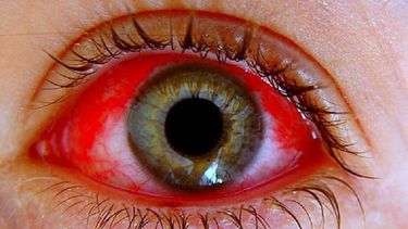 Cuando nos contagiamos de conjuntivitis, los ojos se enrojecen como consecuencia de la dilatación de los capilares que componen la conjuntiva. (Archivo)
