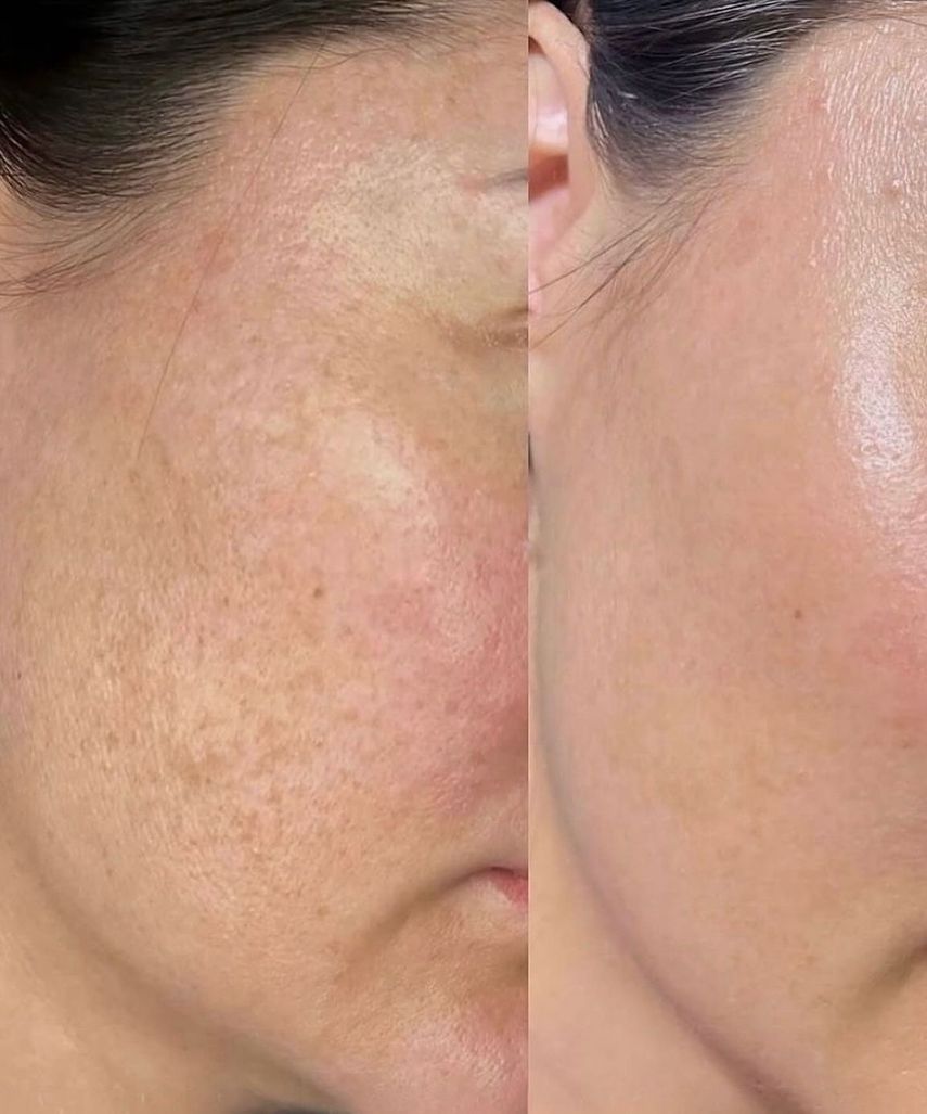 Antes y después de un facial rejuvenecedor.&nbsp;