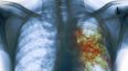 hay mas de 10 millones de personas con tuberculosis en el mundo, alerto la oms