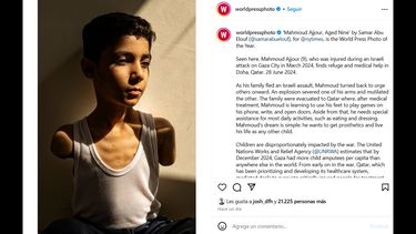 La imagen de un niño palestino de 9 años, que perdió sus dos brazos cuando huía de un ataque israelí en Gaza, de la autoría de la fotógrafa palestina Samar Abu Elouf, gana el World Press Photo 2025.