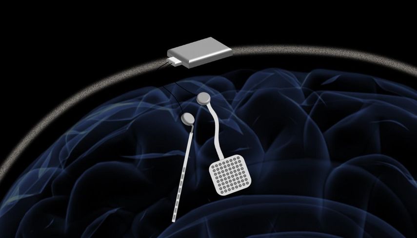 Un nuevo neuroestimulador desarrollado por ingenieros de la Universidad de California, en Berkeley, Estados Unidos, puede escuchar y estimular la corriente eléctrica en el cerebro al mismo tiempo.