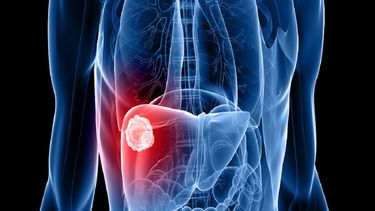 El cáncer de hígado es la segunda causa principal de muertes relacionadas con el cáncer en todo el mundo, y las infecciones por hepatitis B y C son las principales causas.