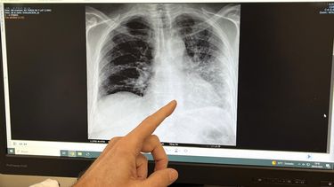Expertos alertan que el tabaquismo sigue siendo la mayor amenaza a la salud