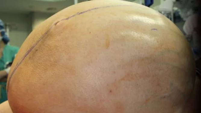 El enorme tumor medía unos 90 centímetros de diámetro.&nbsp;