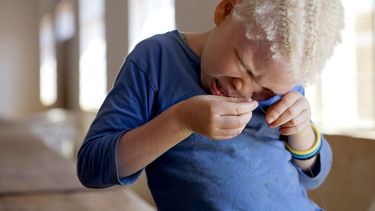 La palabra albinismo deriva del latín “albus”, que significa blanco, y del griego “melan”, que se traduce como negro. (Archivo)