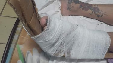 A falta de yeso en los hospitales cubanos utilizan cartón para inmovilizar a quienes sufren algún tipo de fractura