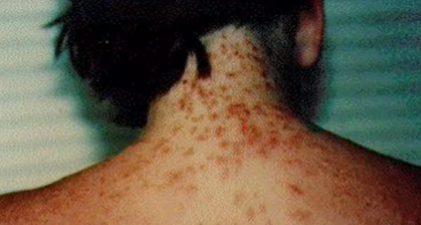 Muchas personas ni siquiera saben que fueron picadas y les aparecen erupciones horas después de haber estado en el agua.