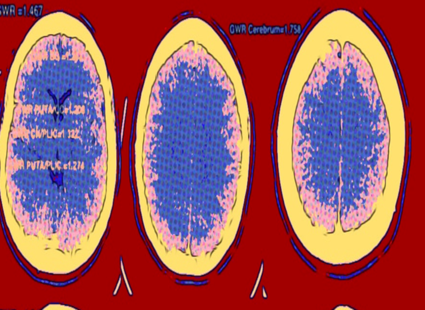 Tomograf&iacute;a de cerebro a paciente con menos de 24 horas de un paro card&iacute;aco