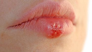 Las autoridades sanitarias calculan que anualmente alrededor de 776.000 personas en los Estados Unidos contraen nuevas infecciones por herpes.(Archivo)