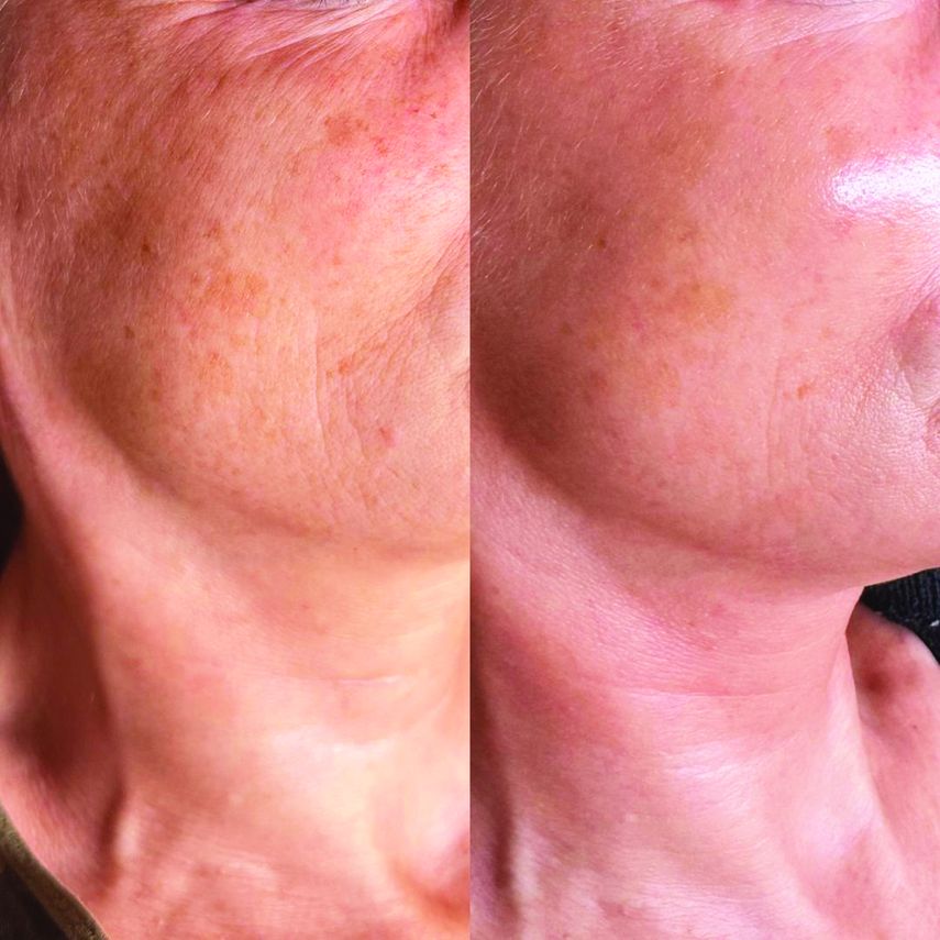 El plasma rico en plaquetas es útil para tratar ojeras y estimular la producción de colágeno y engrosar la piel.